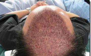 Hair restoration procedure results