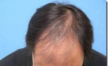 Hair restoration procedure results