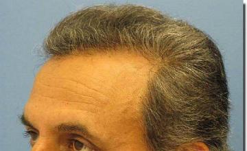 Hair restoration procedure results