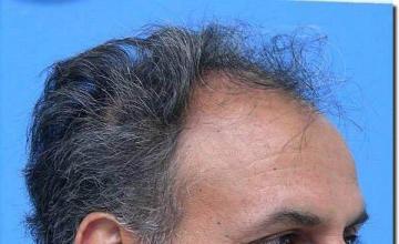 Hair restoration procedure results