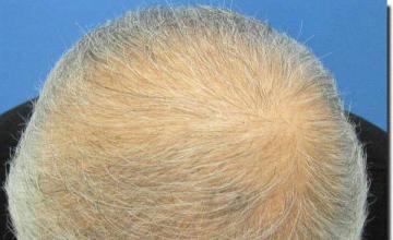 Hair restoration procedure results