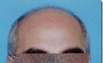 Hair restoration procedure results