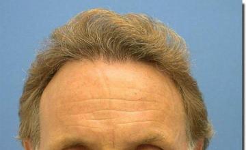 Hair restoration procedure results