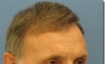 Hair restoration procedure results