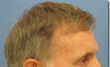 Hair restoration procedure results