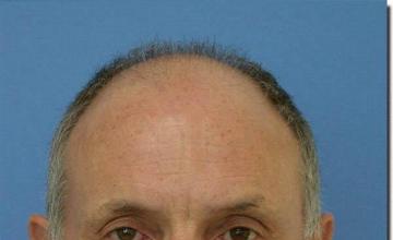 Hair restoration procedure results