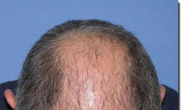 Hair restoration procedure results