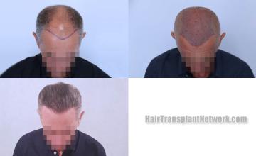 Hair transplantation surgery before and after images