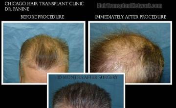 Hair transplantation surgery before and after images