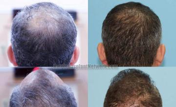Hair transplantation procedure before and after photographs