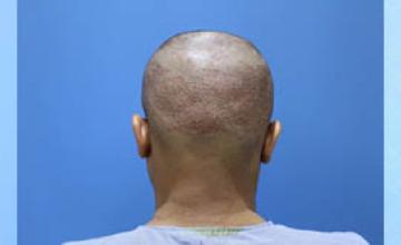Hair replacement surgery before and after images