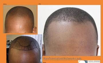 Hair restoration procedure before and after pictures