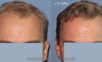 Front view - Before and after hair restoration surgery