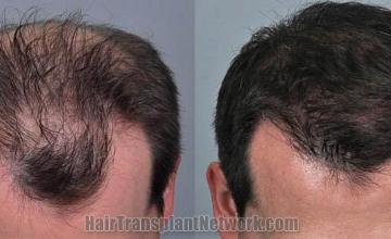 Hair restoration procedure before and after results