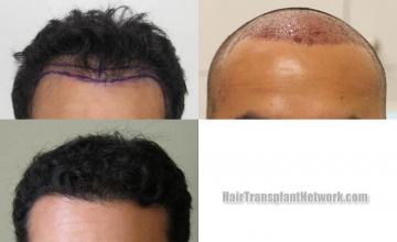 Hair restoration procedure before and after results