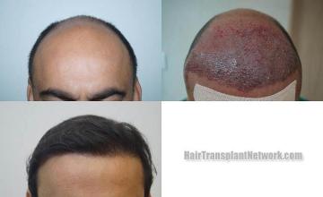 Hair restoration procedure before and after results