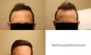 Hair restoration procedure before and after results