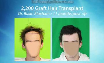 Hair restoration procedure before and after pictures