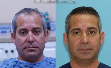 Before and after hair transplantation surgery