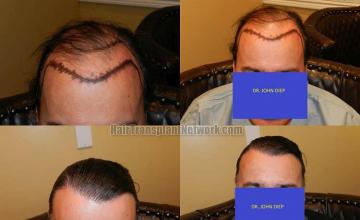 Front view - Before and after hair transplantation surgery
