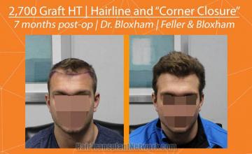 Front view - Before and after hair restoration procedure