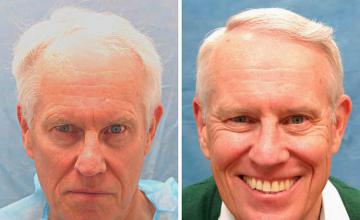 Front view - Before and after