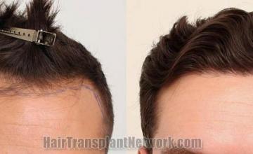 Front view - Before and after