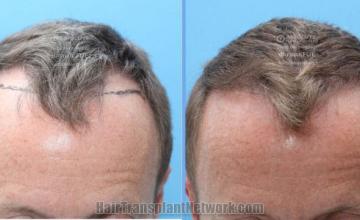 Front view - Before and after