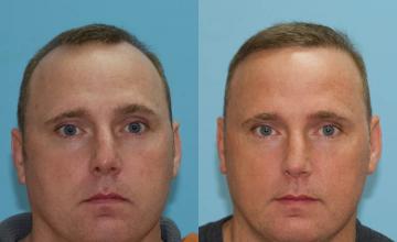 Front view - Before and after hair restoration procedure
