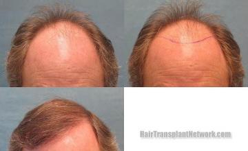 Hair restoration procedure before and after results