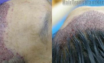 Immediate postoperative hair restoration images