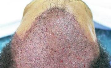 Surgical hair transplantation result photographs