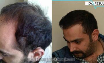 Hair transplantation surgery before and after pictures