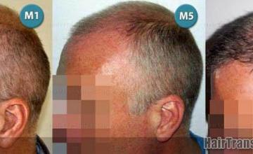  before and after photos