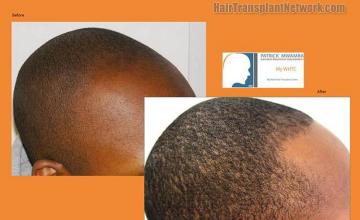 Hair transplantation surgery before and after images