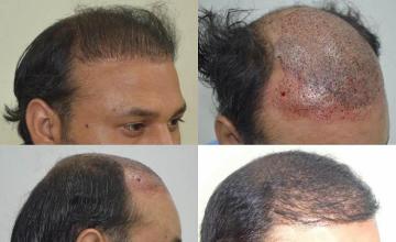 Hair transplantation surgery before and after images