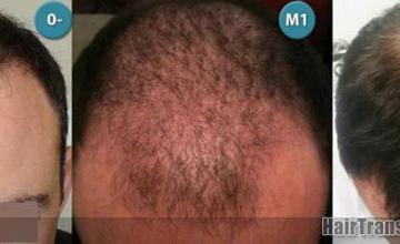 Before and after hair transplantation surgery