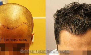 Hair transplantation surgery before and after photos