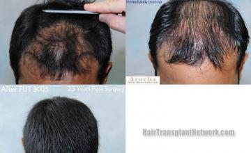 Hair restoration procedure before and after results