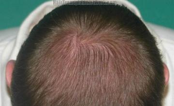 Hair transplant surgery before and after photos