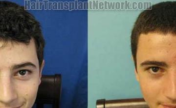 Before and after hair restoration procedure images