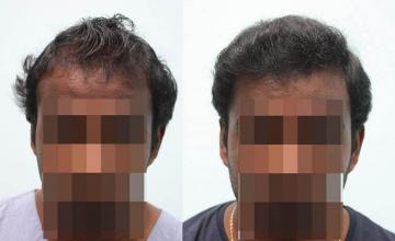 Hair restoration procedure before and after results