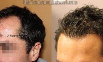 Hair transplantation surgery before and after pictures