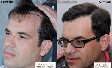 Hair transplantation surgery before and after images