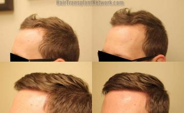 Hair restoration procedure before and after results