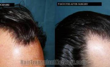 Before and after hair transplant procedure images