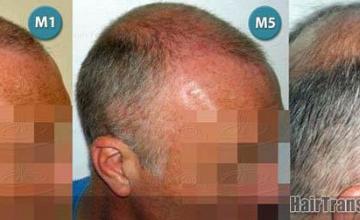 Hair restoration procedure before and after pictures