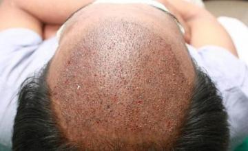 Hair transplant surgery before and after images