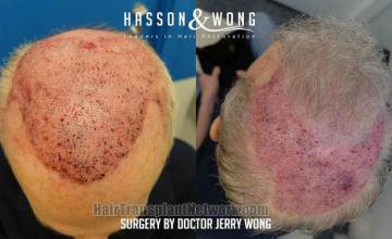 Hair transplantation surgery before and after photos