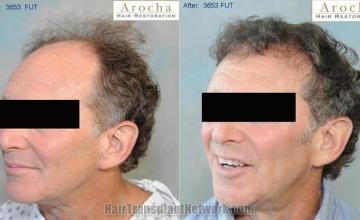 Before and after surgical hair restoration images